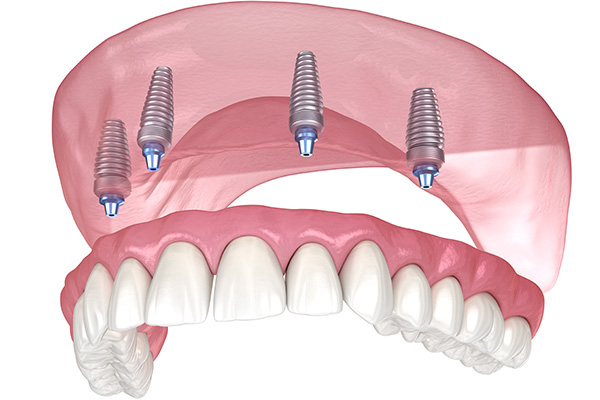 Implant Dentures
