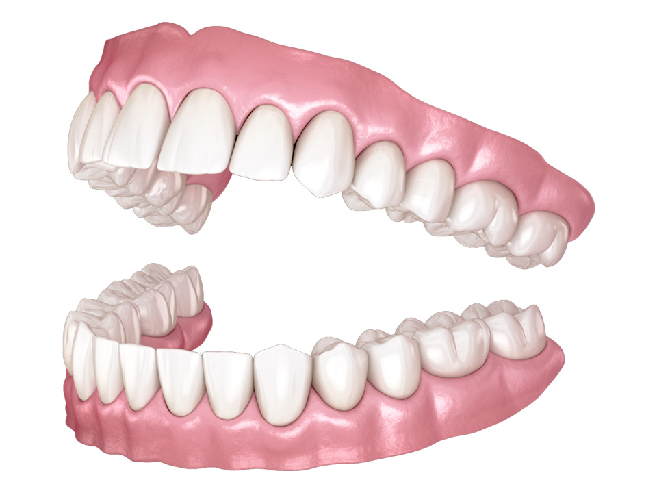 Full (Complete) Dentures