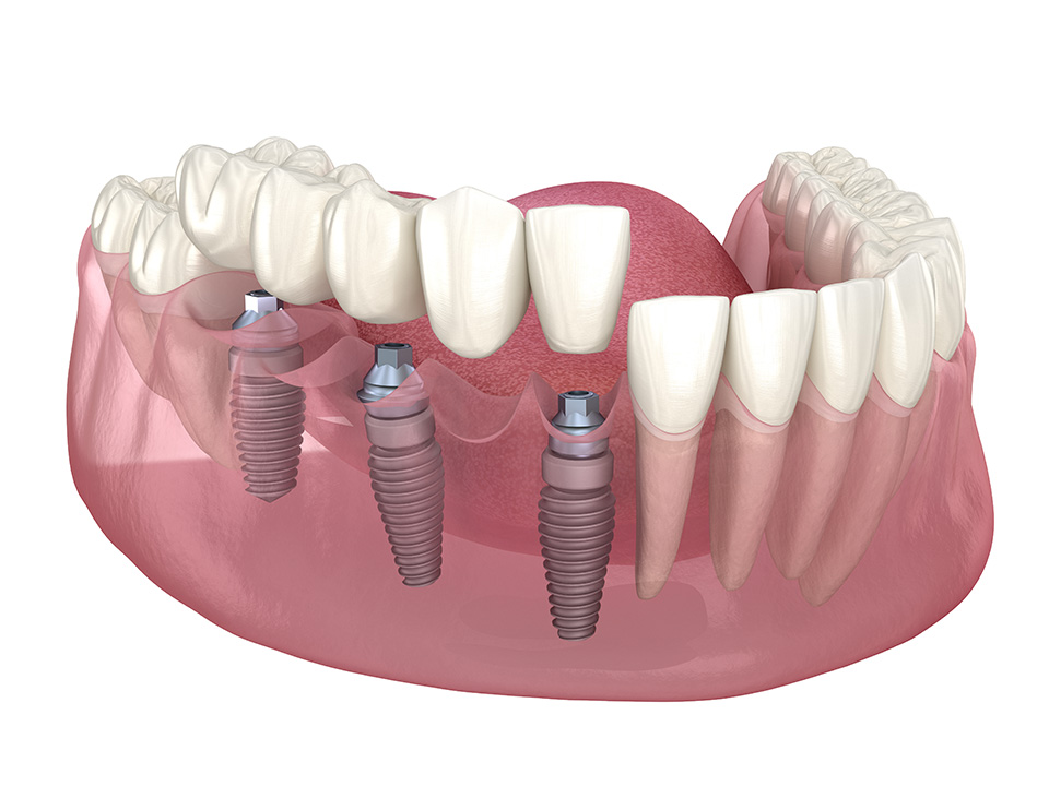 Multiple Dental Implants Multiple Tooth Implants