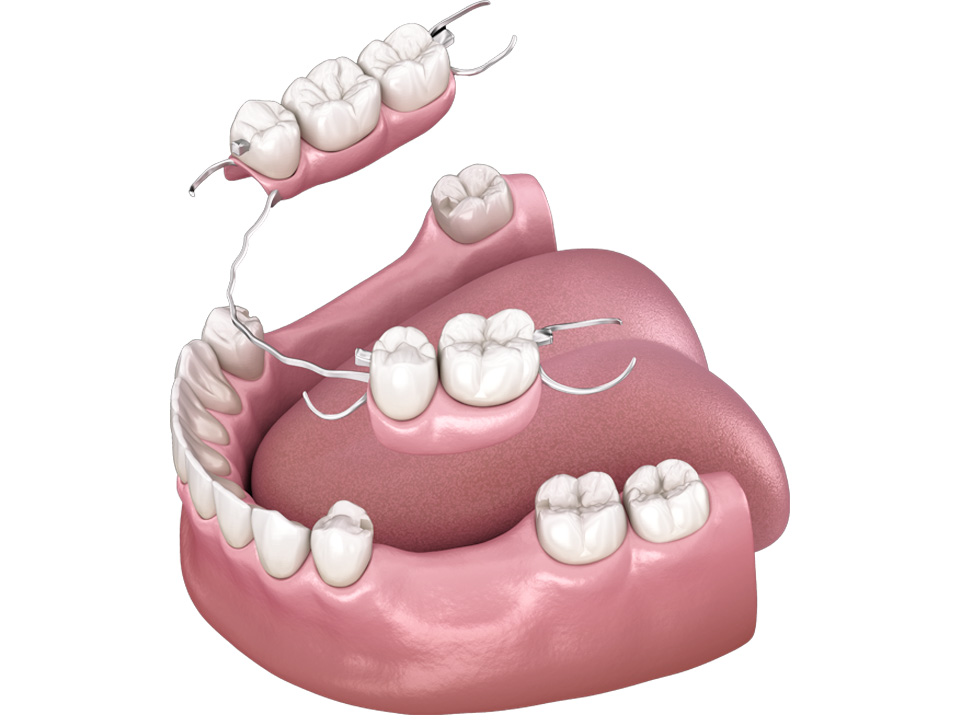 Partial Dentures