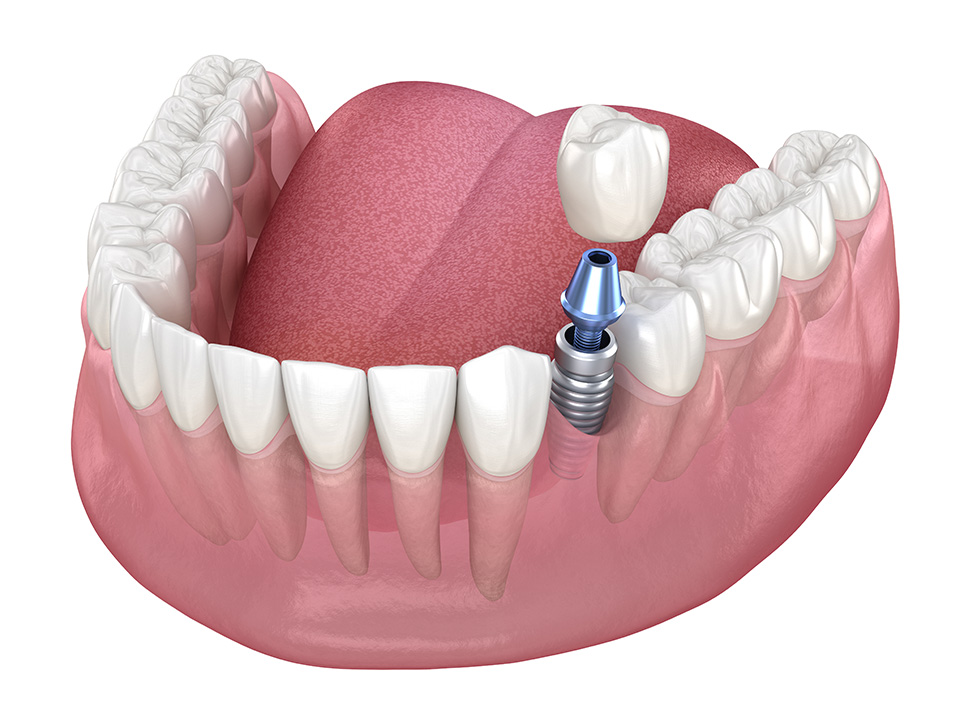 Single Dental Implant Single Tooth Implants