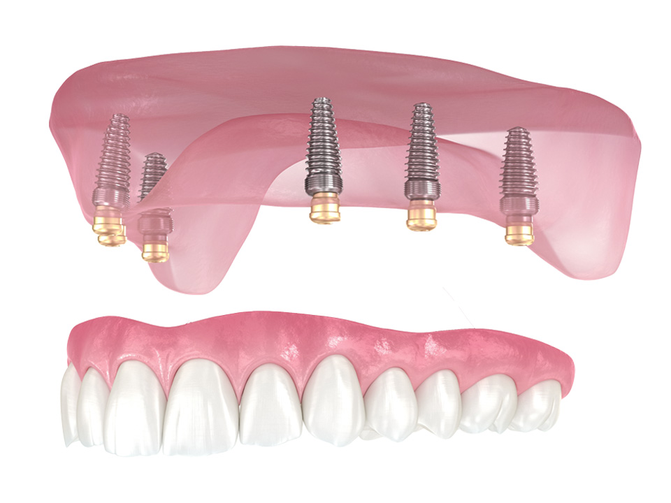 SureLOCK® Fixed Implant Dentures