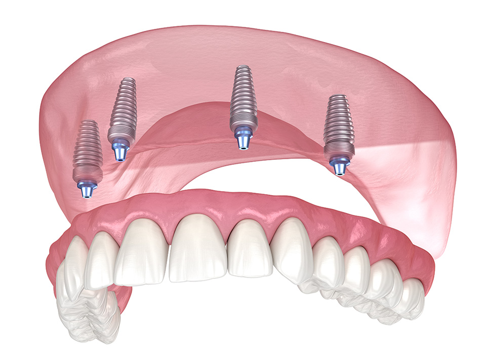 SureSNAP® Removable Implant Dentures